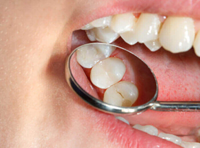 Fissurotomy & Sealant Application Dental Treatment
