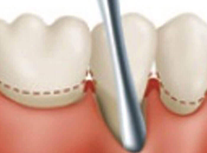 Mucogingival Surgeries Dental Treatment In Ernakulam