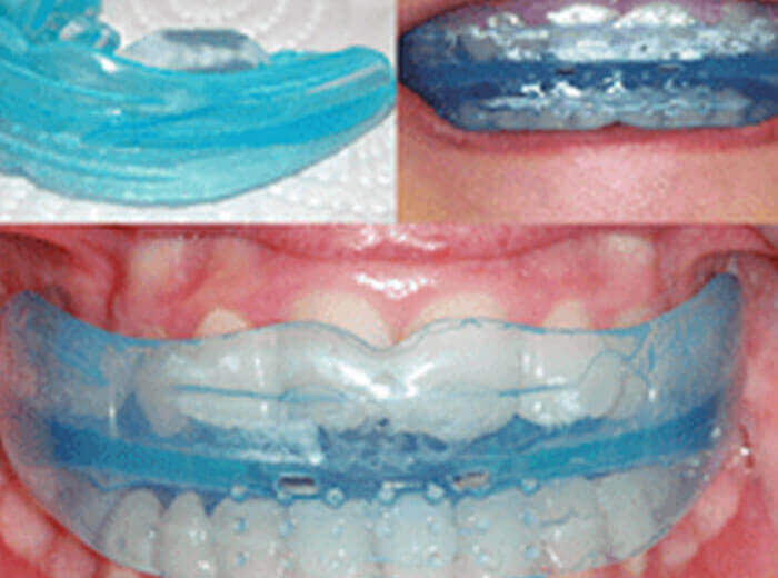 Myofunctional Braces Dental Treatment