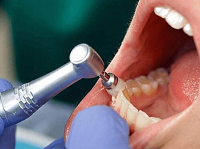 Oral Prophylaxis Dental Treatment In Ernakulam