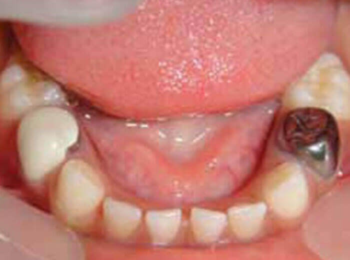 Performed Crowns Dental Treatment In Ernakulam