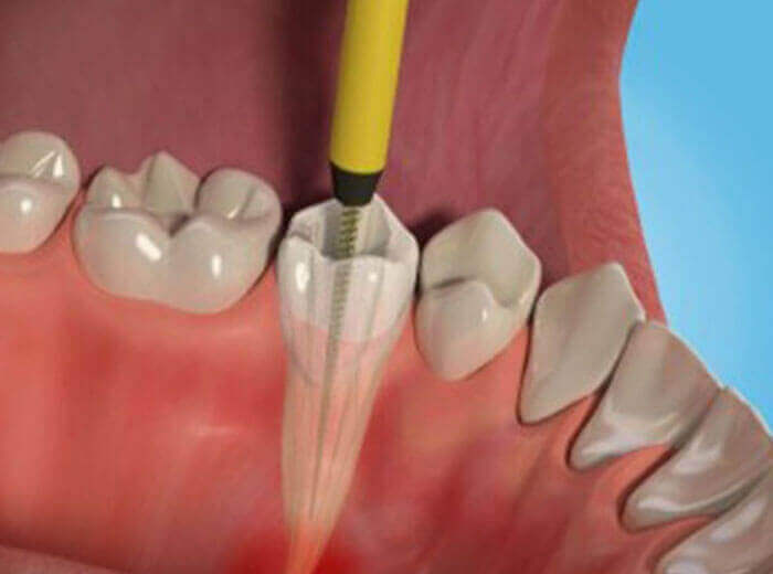 Root Canal Treatment In Kochi