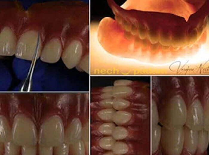 Acrylic Removable Complete Dentures