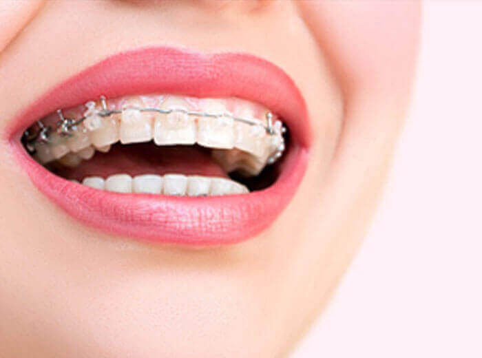 Damon Clear Braces Dental Treatment In Kochi