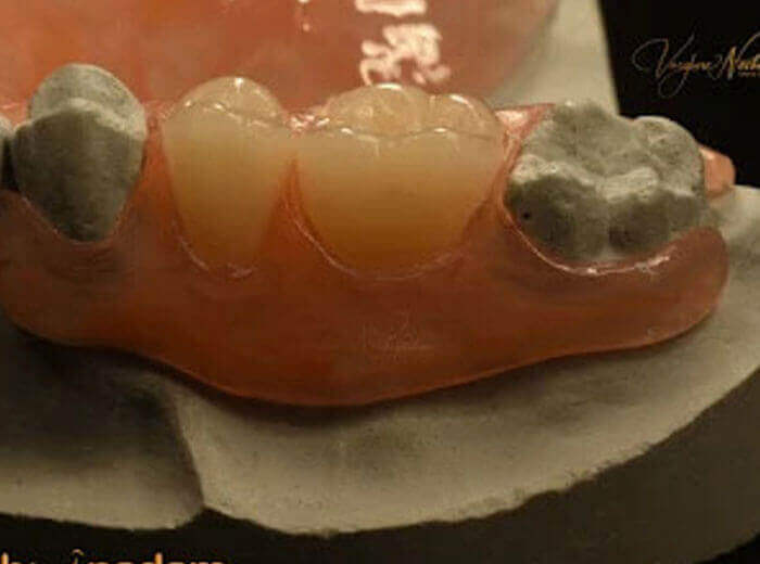 Removable Flexible Denture Dental Treatment in Ernakulam